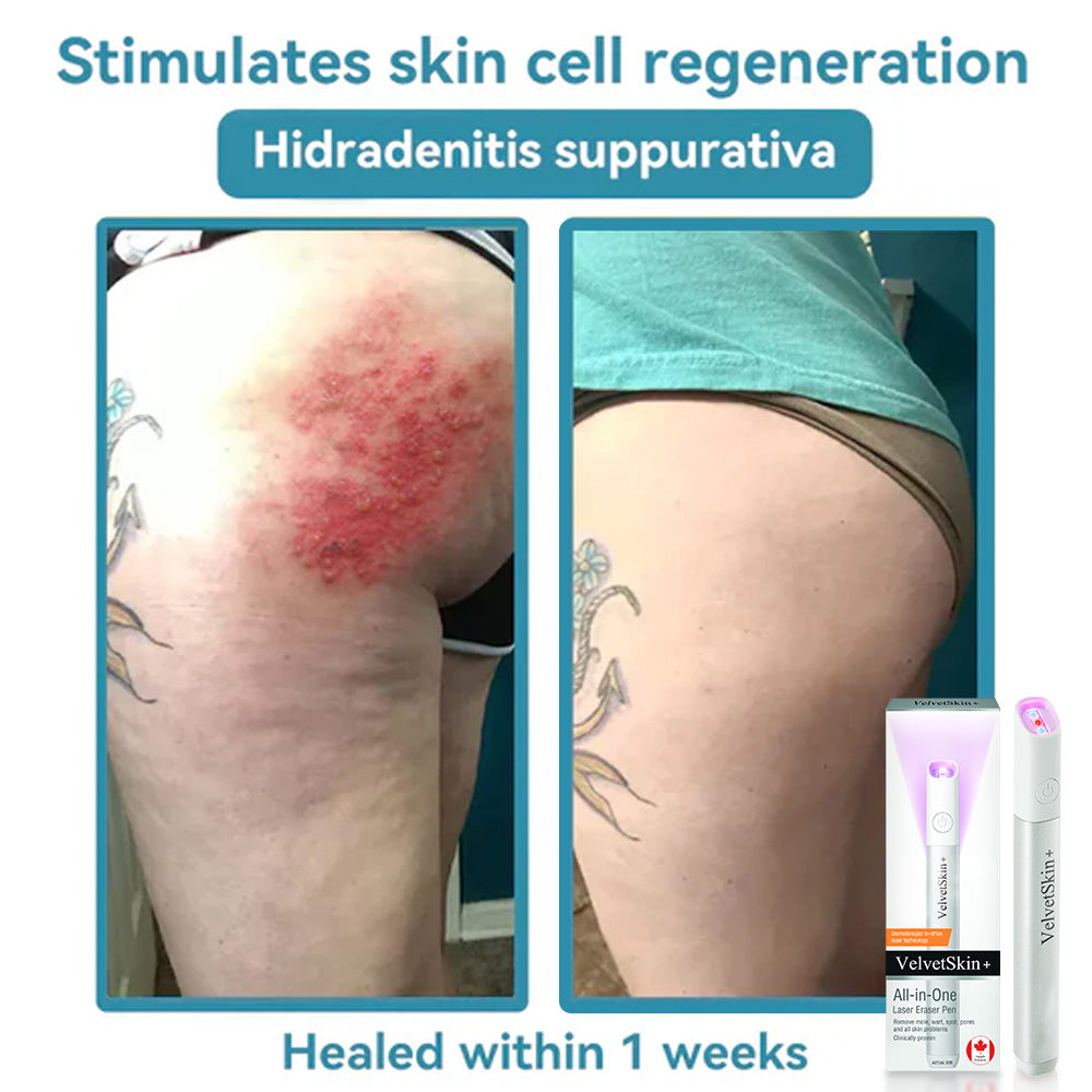 Skin Laser Pen Micro-Focused CO2 Handheld