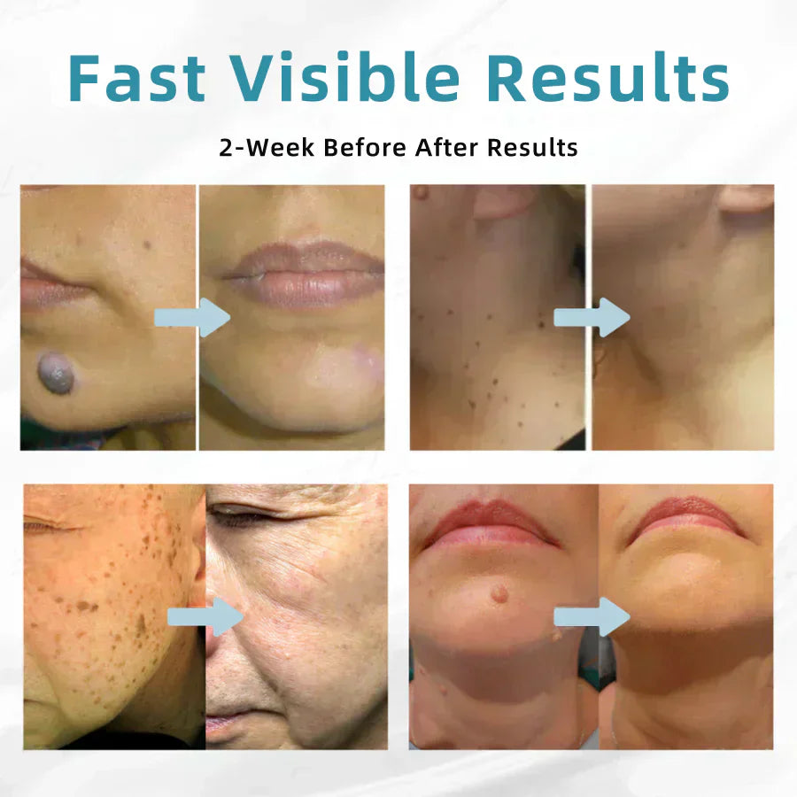 Skin Laser Pen Micro-Focused CO2 Handheld