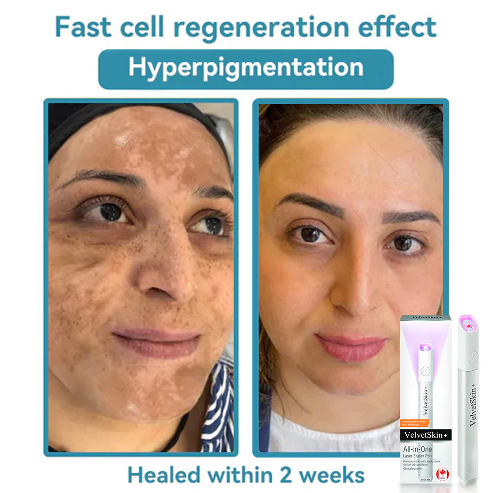 Skin Laser Pen Micro-Focused CO2 Handheld