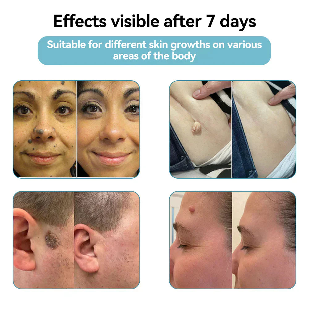 Skin Laser Pen Micro-Focused CO2 Handheld
