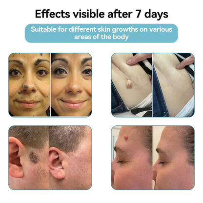 Skin Laser Pen Micro-Focused CO2 Handheld