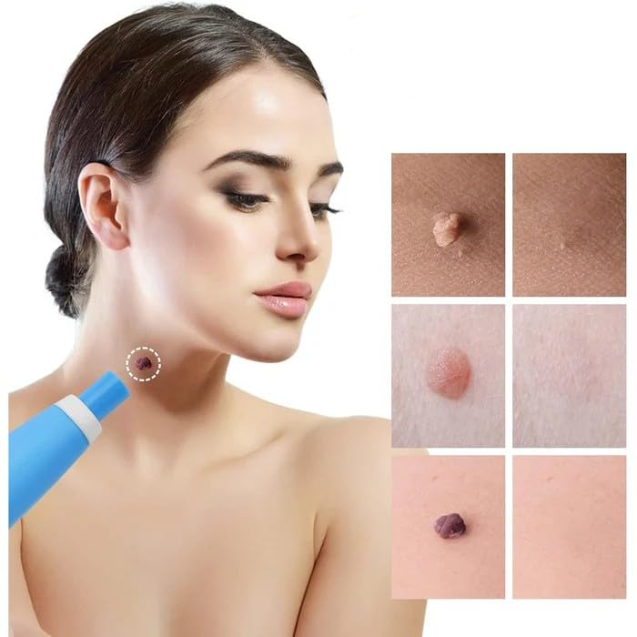 Skin Spot Remover Kit Pain-Free Silicone Bands Two Sizes