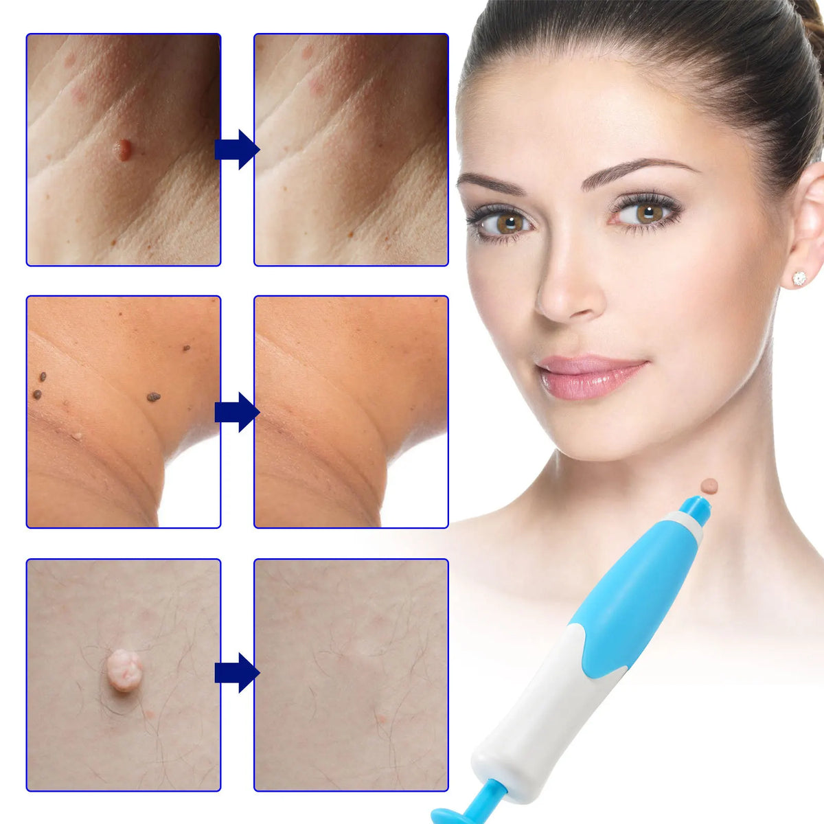 Skin Spot Remover Kit Pain-Free Silicone Bands Two Sizes