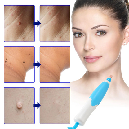Skin Spot Remover Kit Pain-Free Silicone Bands Two Sizes