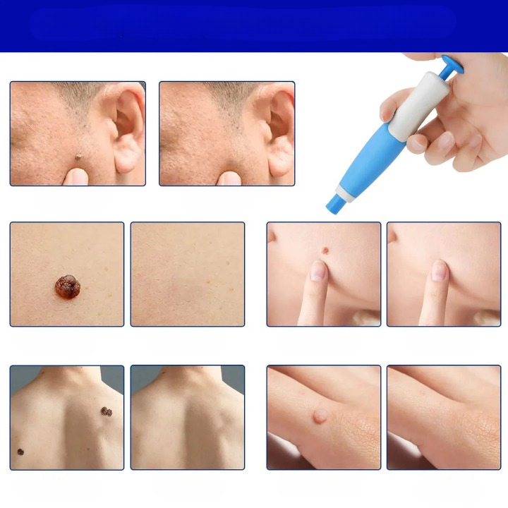 Skin Spot Remover Kit Pain-Free Silicone Bands Two Sizes