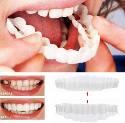 QuickSmile Complete Veneer Set for Upper and Lower Teeth