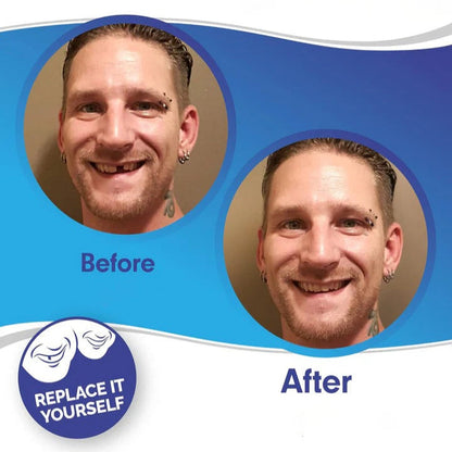 Snap-On Smile Enhancer for Ultimate Confidence
