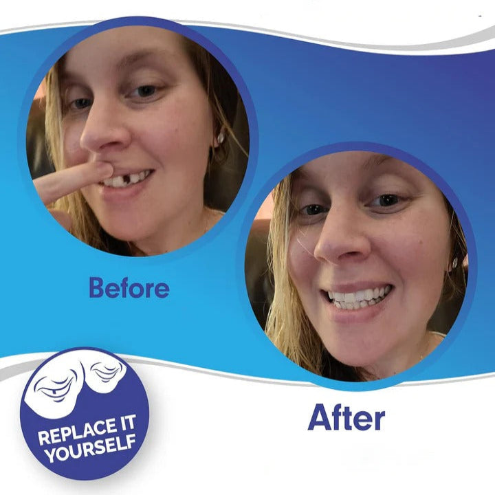 Snap-On Smile Enhancer for Ultimate Confidence
