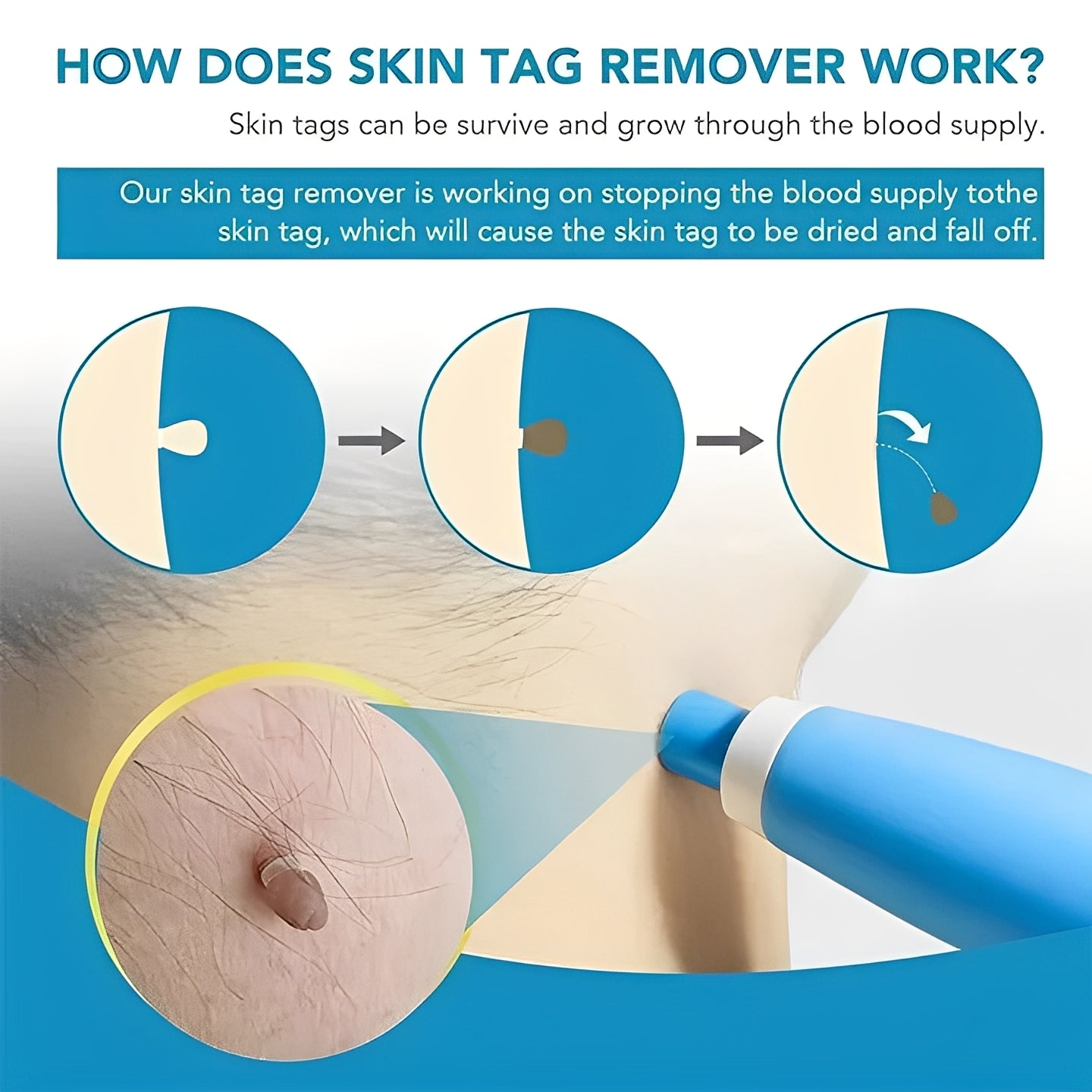 Skin Tag Removal Kit with Easy Applicator and Bands