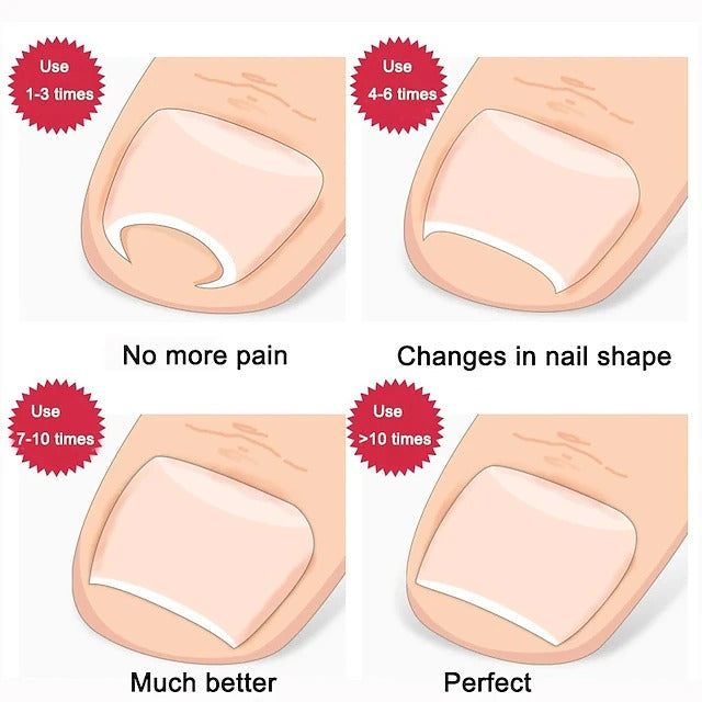 Dual Stainless Steel Toenail Straightening Tool Set for Home Care