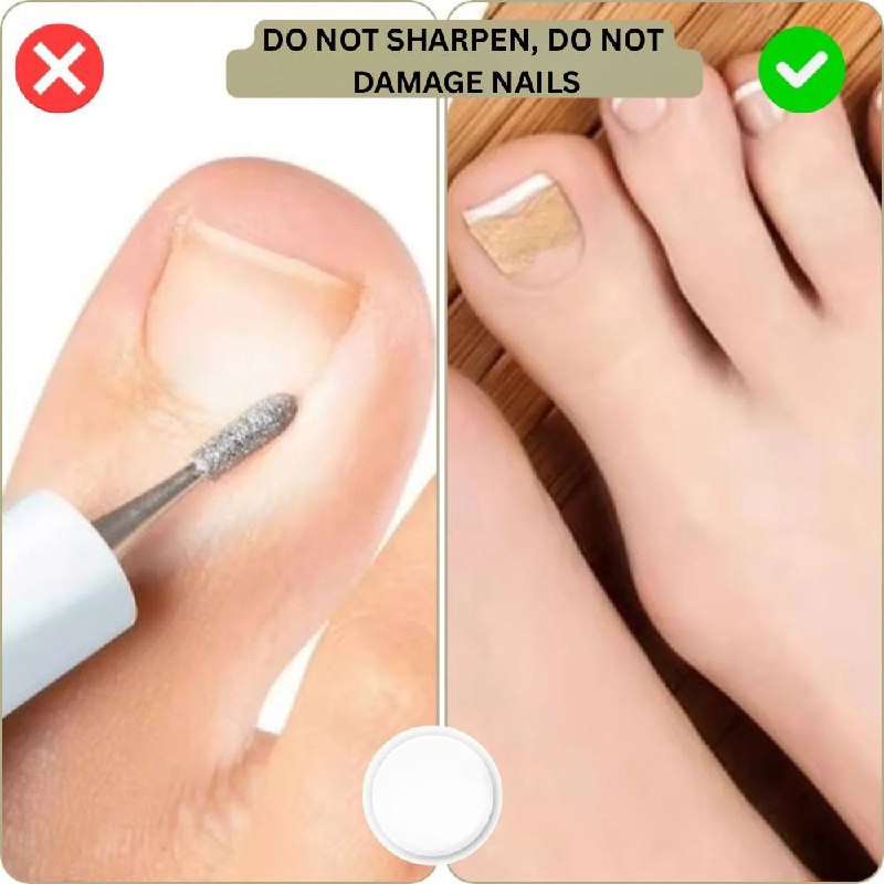 Rapid Nail Repair Solution for Ingrown and Damaged Nails