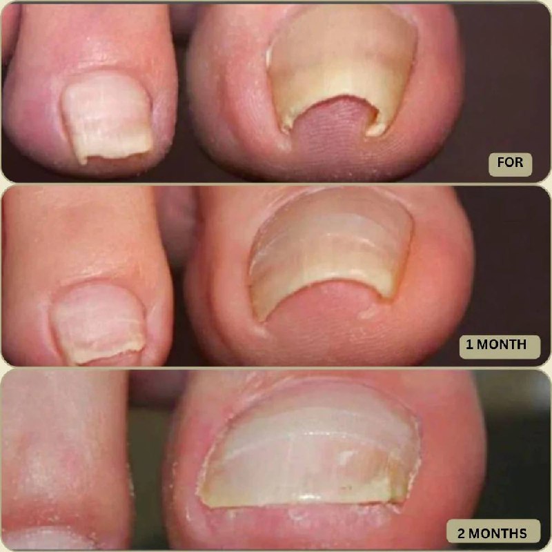 Rapid Nail Repair Solution for Ingrown and Damaged Nails