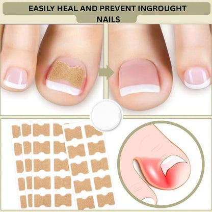 Rapid Nail Repair Solution for Ingrown and Damaged Nails